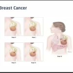 Breast Cancer: Overview for Everyone by Muhammad Usama J